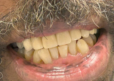 patient photo showing beautiful upper arch - implants plus single crowns