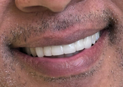 close up of man with beautiful smile due to upper anterior bridge