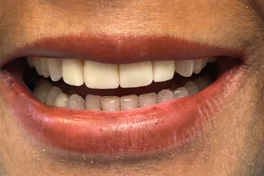 close-up of woman's attractive smile showing porcelain veneers that were placed over 25 years ago