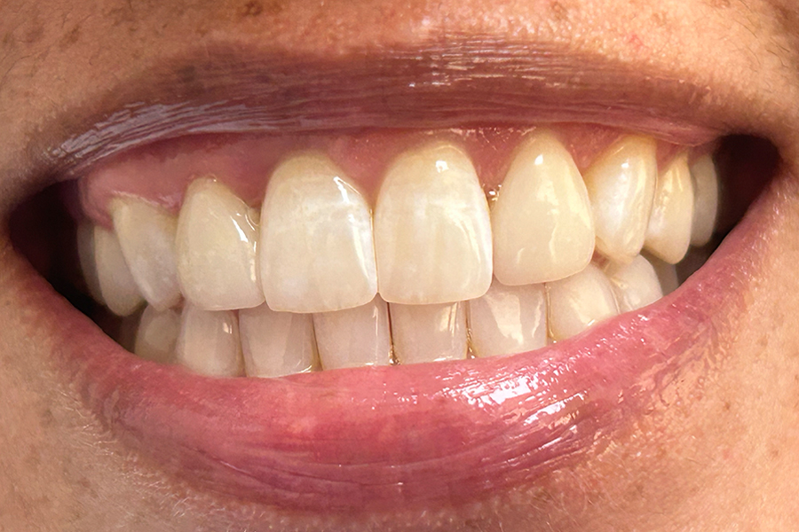 close-up of woman's attractive smile showing porcelain veneers that were placed over 25 years ago